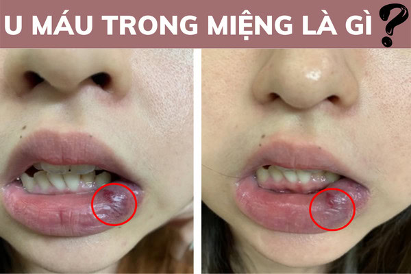 U máu trong miệng là gì?