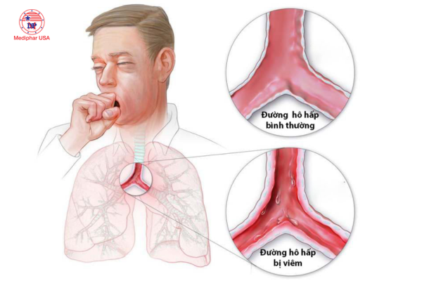 Bệnh viêm hô hấp trên ở người lớn
