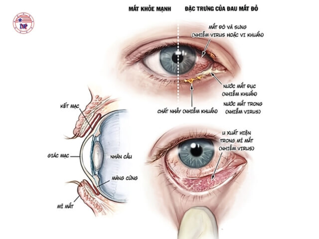  Biểu hiện đau mắt đỏ