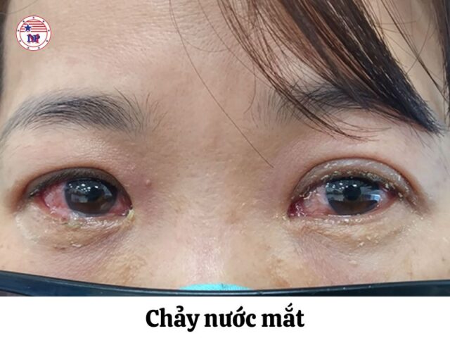 Chảy nước mắt