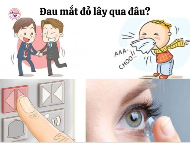 Đau mắt đỏ lây qua đâu? 