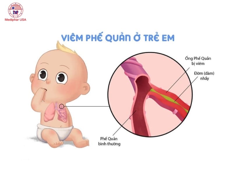 Viêm phế quản ở trẻ em bao lâu thì khỏi? Triệu chứng, Cách trị