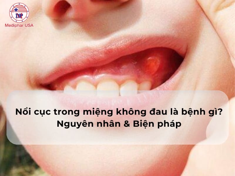 Nổi cục trong miệng không đau là bệnh gì? Nguyên nhân & Biện pháp