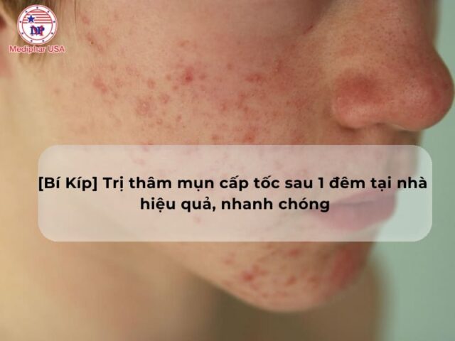 [Bí Kíp] Trị thâm mụn cấp tốc sau 1 đêm tại nhà hiệu quả, nhanh chóng