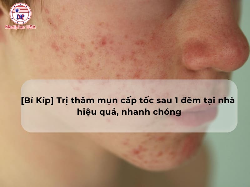 [Bí Kíp] Trị thâm mụn cấp tốc sau 1 đêm tại nhà hiệu quả, nhanh chóng