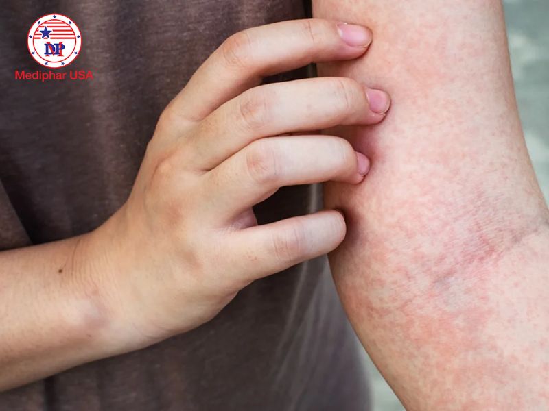 Công dụng của la hán quả với sức khỏe và cách sử dụng an toàn hiệu quả Các thành phần của la hán quả có thể cho tác dụng kháng histamin cho người dùng