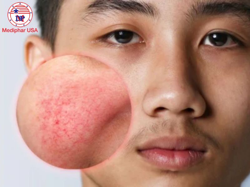 NAD+ là gì? Tìm hiểu tác dụng của NAD+ đối với sức khỏe Đỏ bừng da trong thời gian ngắn có thể xuất hiện trong quá trình bổ sung NAD+