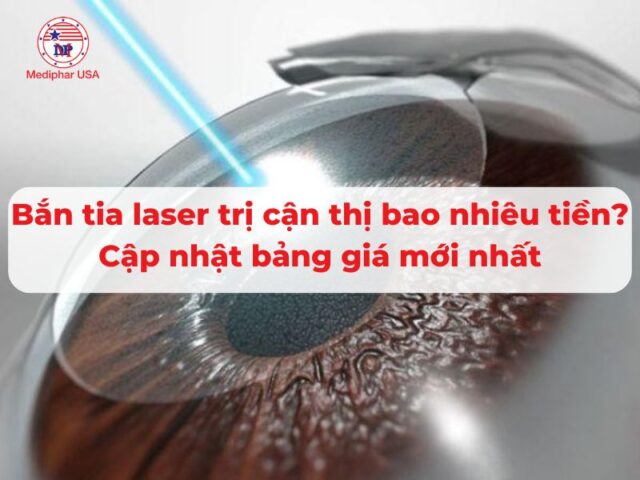 bắn tia laser trị cận thị bao nhiêu tiền