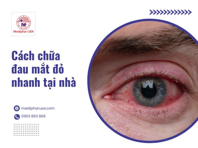 Mẹo chữa đau mắt đỏ nhanh nhất