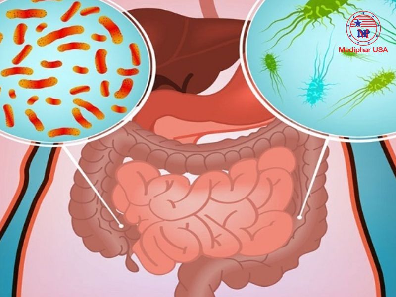 Nhiễm khuẩn đường tiêu hóa có thể gây đau bụng quặn từng cơn kèm tiêu chảy buồn nôn​