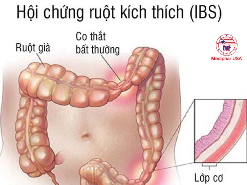 Hội chứng ruột kích thích
