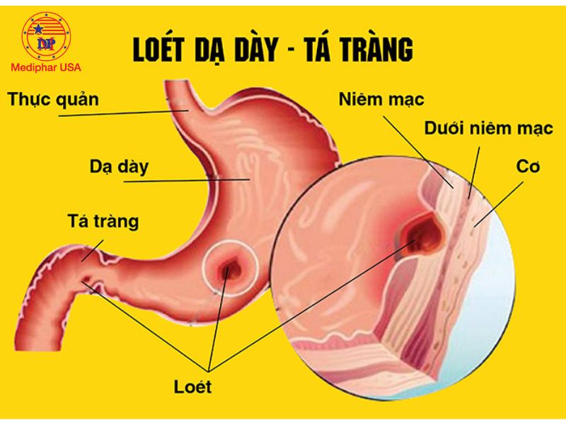 Viêm loét dạ dày - tá tràng