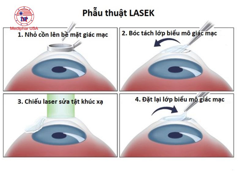 Top 8 điều cần biết trước khi mổ mắt cận thị Hình ảnh mô tả quá trình thực hiện LASEK