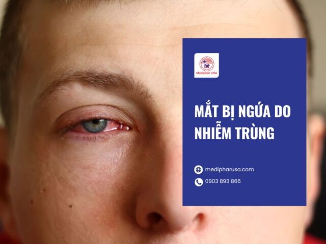 Ngứa mắt là bị gì? Nguyên nhân, dấu hiệu và cách trị Mắt bị ngứa do nhiễm trùng