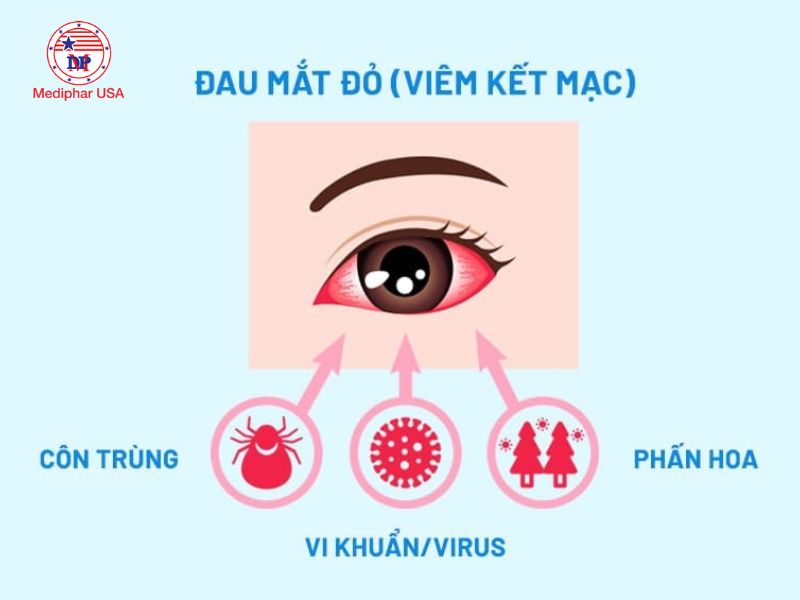 Tìm hiểu phác đồ điều trị đau mắt đỏ Bộ Y tế Đau mắt đỏ có nhiều nguyên nhân gây bệnh khác nhau