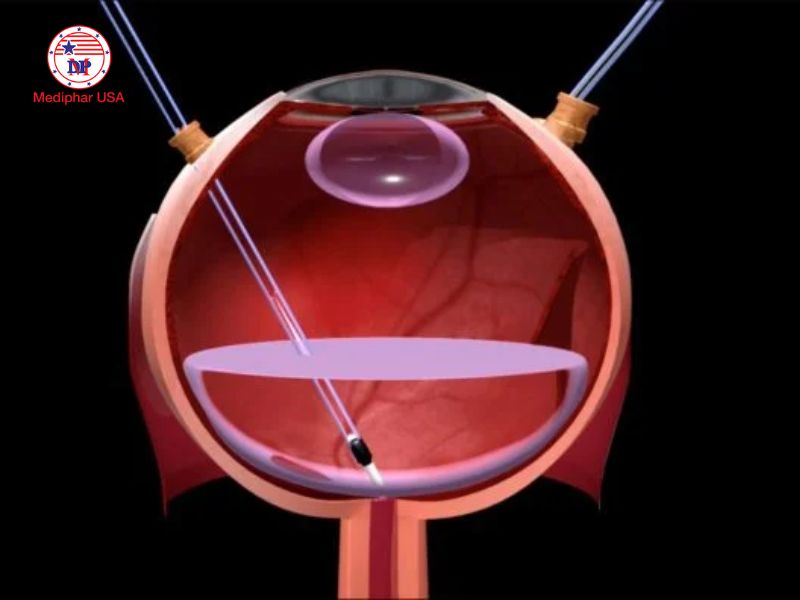 Thoái hóa võng mạc cận thị: Nguyên nhân, cách nhận biết và phòng ngừa Liệu pháp tế bào gốc là một trong những nghiên cứu công nghệ cao những năm gần đây