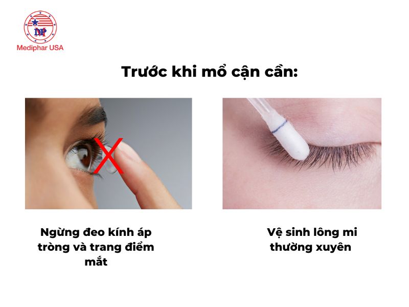 Cách chăm sóc mắt sau khi mổ cận thị đúng