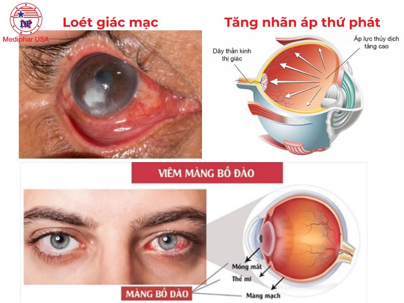 Mắt mờ sau khi bị đau mắt đỏ có nguy hiểm không? Mắt mờ sau khi bị đau mắt đỏ do biến chứng