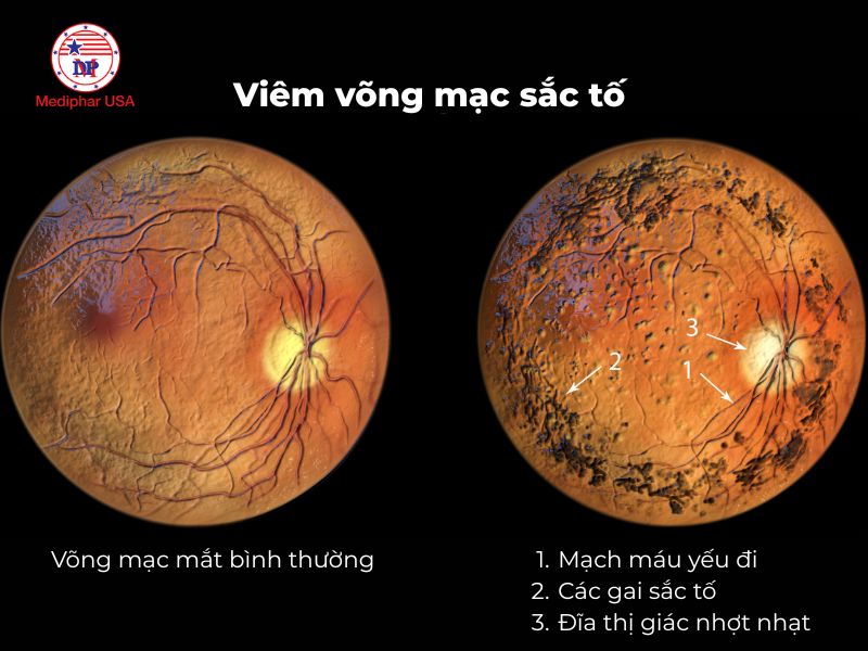 Quáng gà là gì? Nguyên nhân, triệu chứng và cách trị Nguyên nhân gây quáng gà