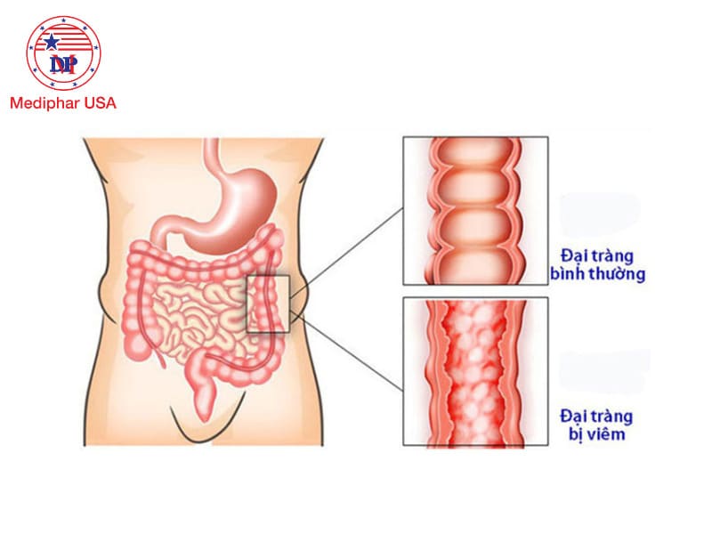 Bụng sôi liên tục và xì hơi: Nguyên nhân và cách khắc phục hiệu quả Viêm đại tràng cũng góp phần gây ra tình trạng bụng sôi, xì hơi.