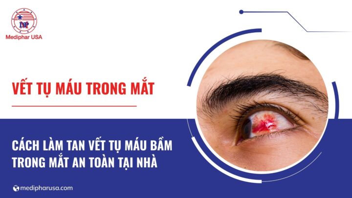 Cách làm tan vết tụ máu bầm trong mắt