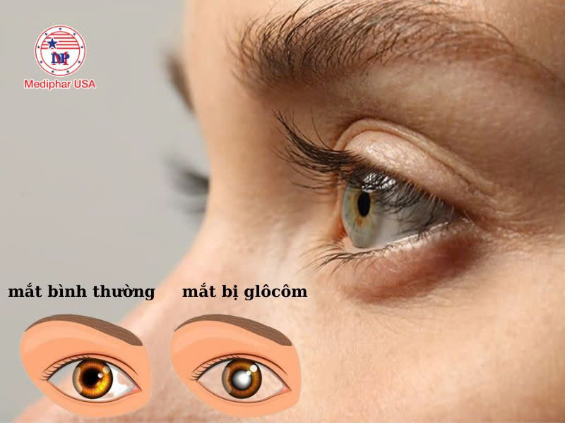 Đục thủy tinh thể có nguy hiểm không? Biến chứng thường gặp Đục thủy tinh thể có thể gây ra các biến chứng gì