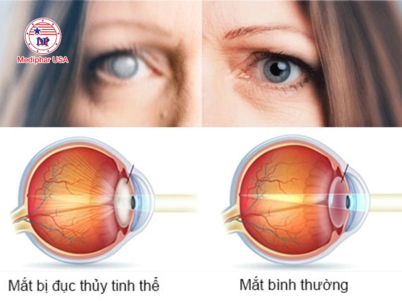 Đục thủy tinh thể là gì? Dấu hiệu, nguyên nhân và cách trị Đục thủy tinh thể là gì?