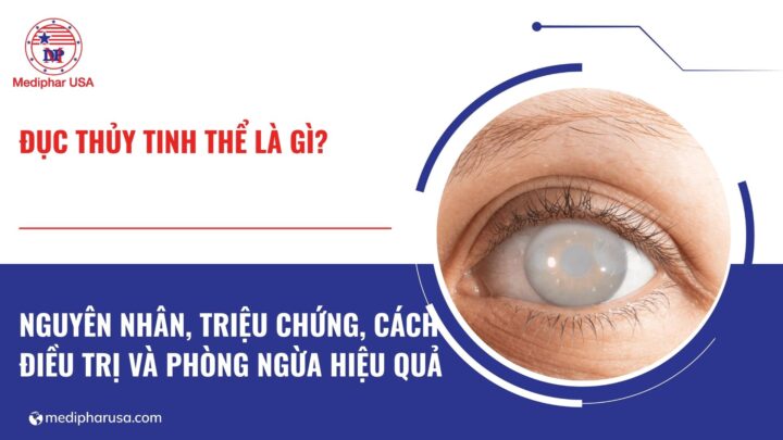 Đục thủy tinh thể