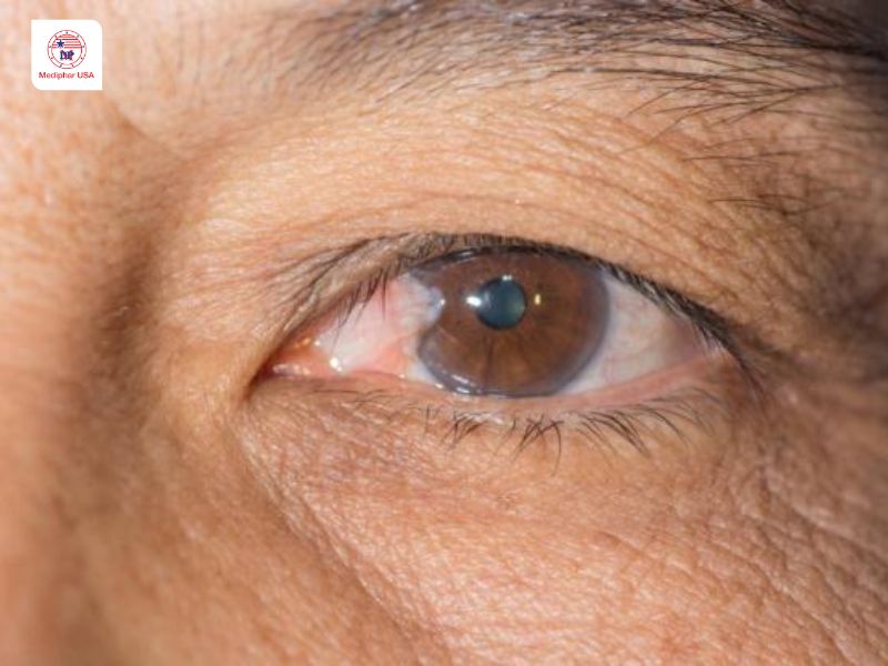 Tăng nhãn áp là gì? Dấu hiệu, nguyên nhân và cách điều trị Hình ảnh tăng nhãn áp ở người già