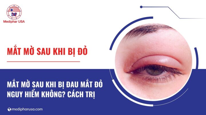 Mắt mờ sau khi bị đau mắt đỏ có nguy hiểm không?