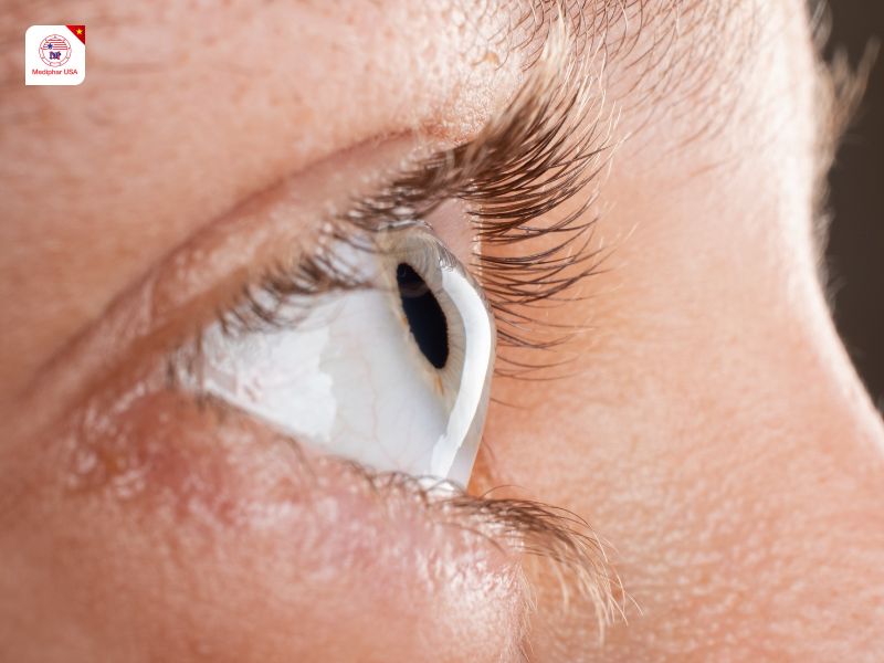 Những biến chứng có thể gặp khi mổ cận thị