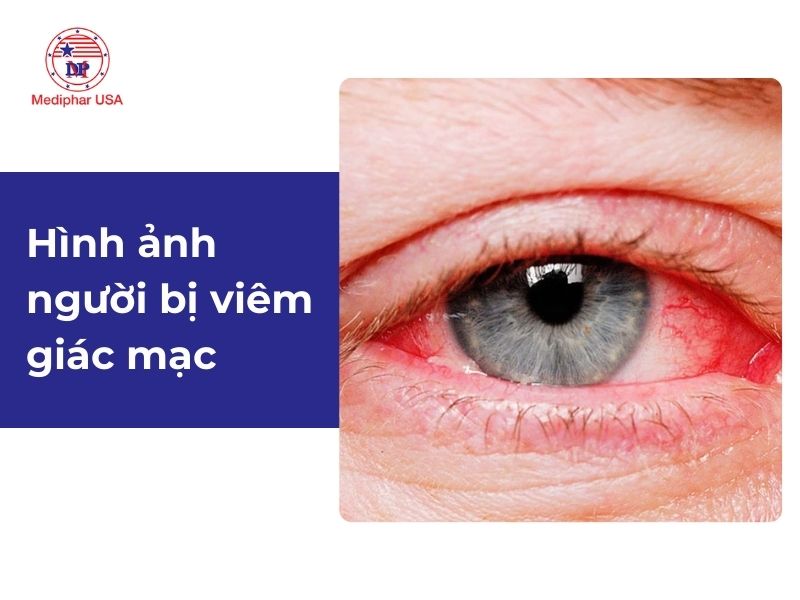 Viêm giác mạc: Nguyên nhân, dấu hiệu và cách điều trị Viêm giác mạc là gì?