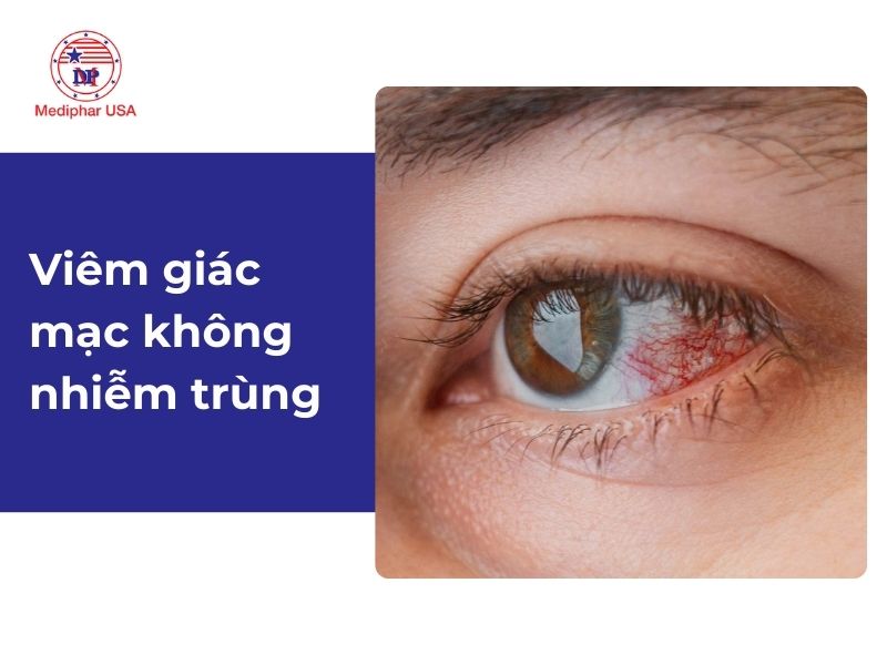 Viêm giác mạc: Nguyên nhân, dấu hiệu và cách điều trị Viêm giác mạc do chấn thương