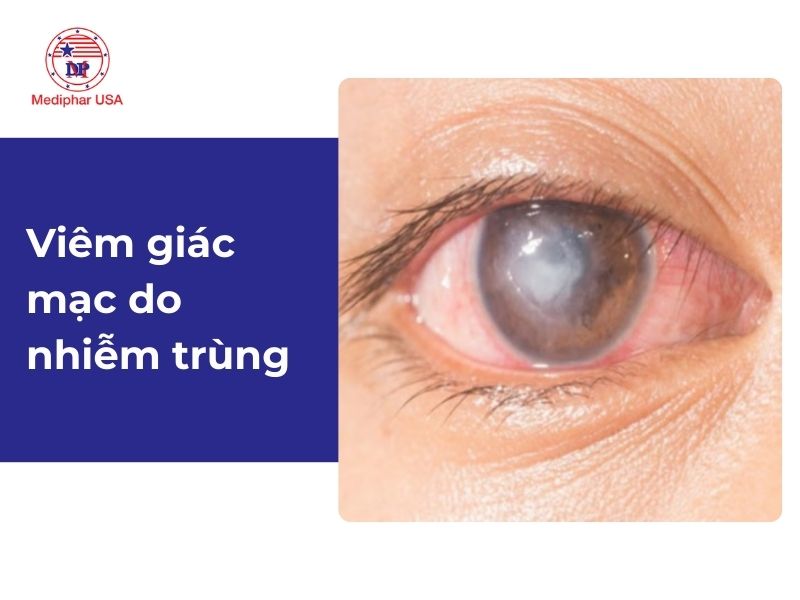 Viêm giác mạc: Nguyên nhân, dấu hiệu và cách điều trị Viêm giác mạc do nhiễm trùng