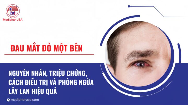 Đau mắt đỏ 1 bên