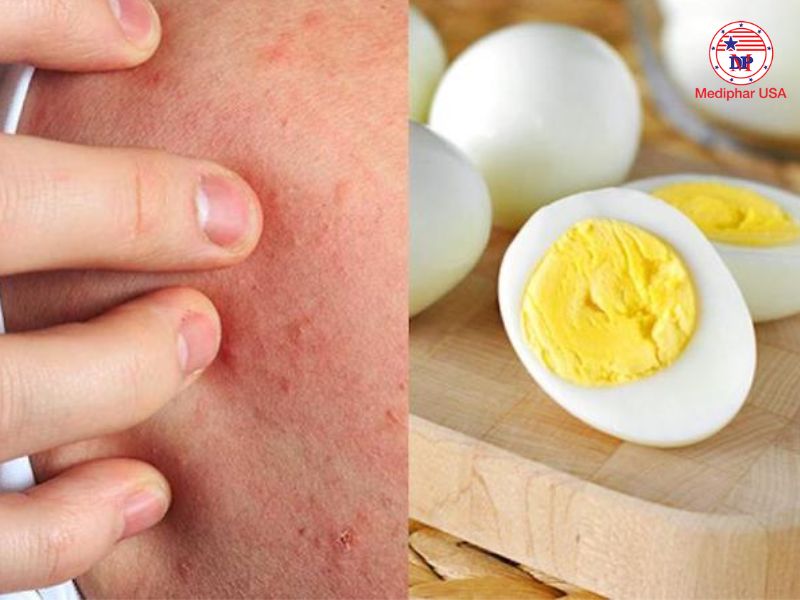 Ăn trứng bị đầy bụng: Nguyên nhân và cách xử lý hiệu quả Một số trường hợp có thể bị dị ứng hoặc không dung nạp với trứng