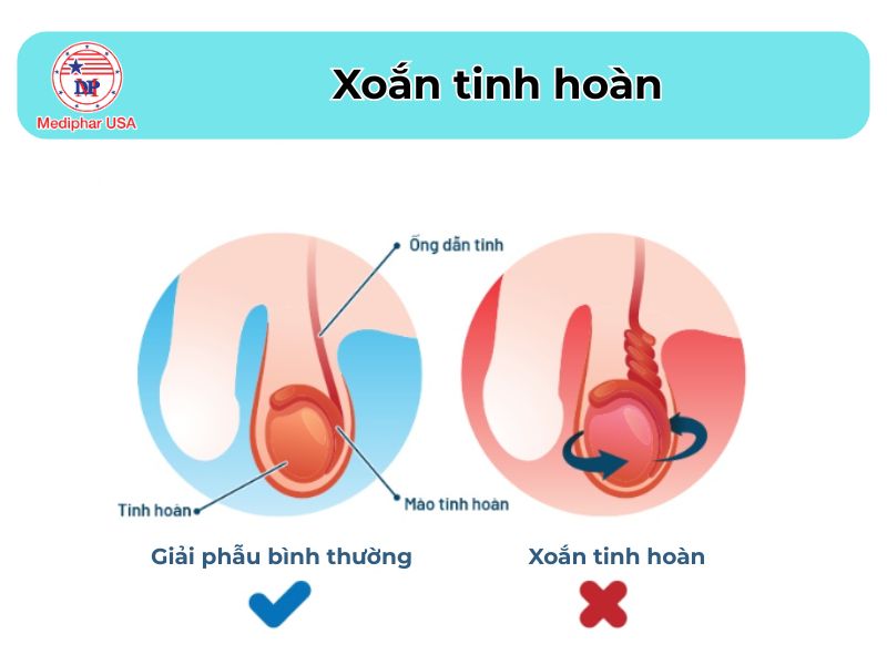 Đau bụng bên trái: Nguyên nhân, cách điều trị và phòng tránh Xoắn tinh hoàn là một trong những nguyên nhân gây đau bụng bên trái nam