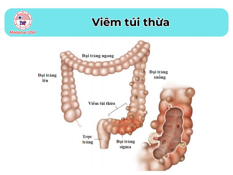 Đau bụng bên trái: Nguyên nhân, cách điều trị và phòng tránh Viêm túi thừa gây đau bụng bên trái