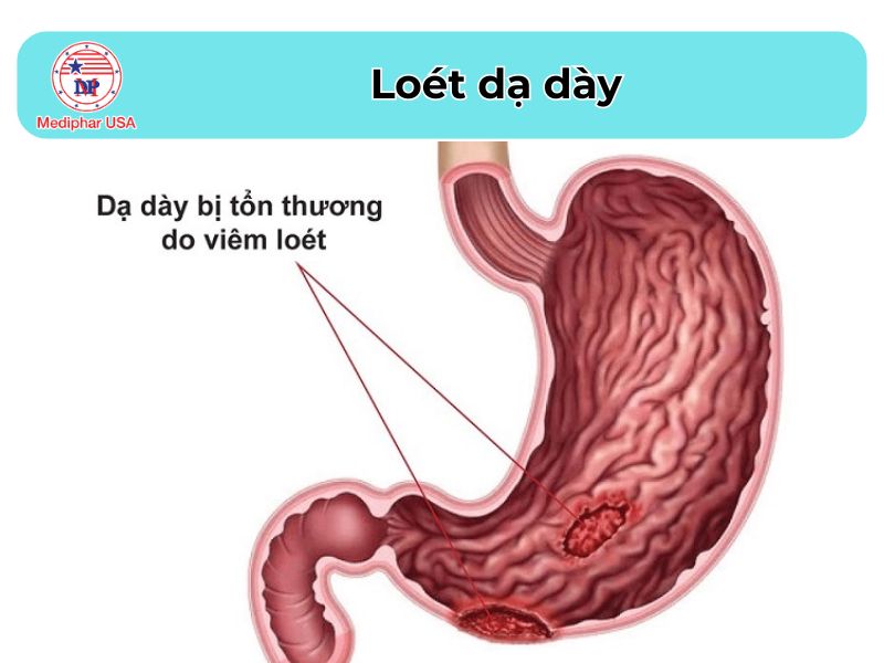 Đau bụng bên trái: Nguyên nhân, cách điều trị và phòng tránh Loét dạ dày khiến đau bụng bên trái kèm những triệu chứng khác