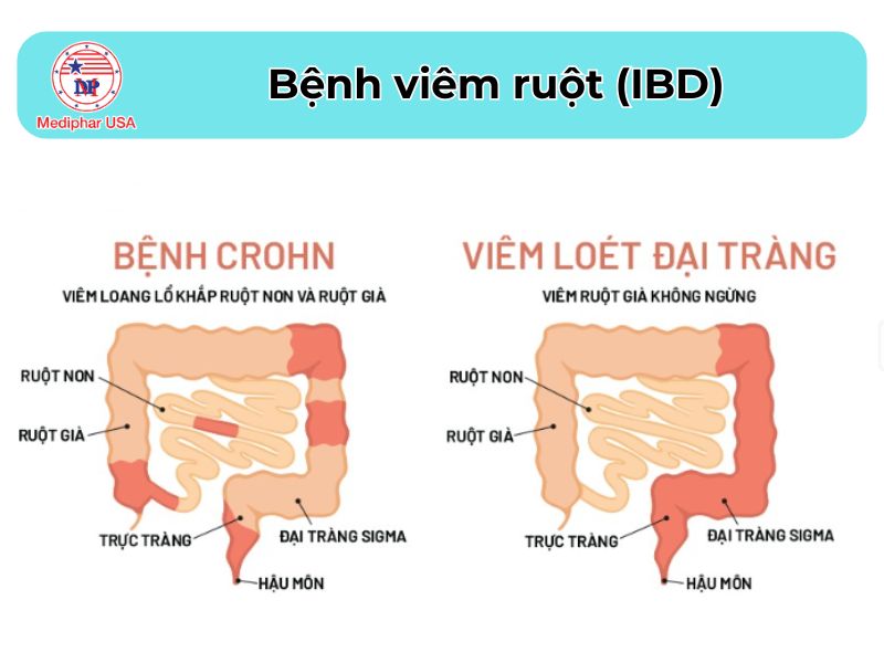 Đau bụng bên trái: Nguyên nhân, cách điều trị và phòng tránh Bệnh viêm ruột bao gồm những bệnh lý mãn tính có thể gây đau bụng dưới bên trái