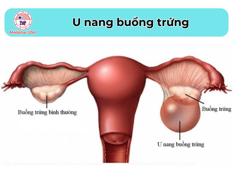 Đau bụng bên trái: Nguyên nhân, cách điều trị và phòng tránh U nang buồng trứng là một trong những nguyên nhân gây đau bụng bên trái nữ