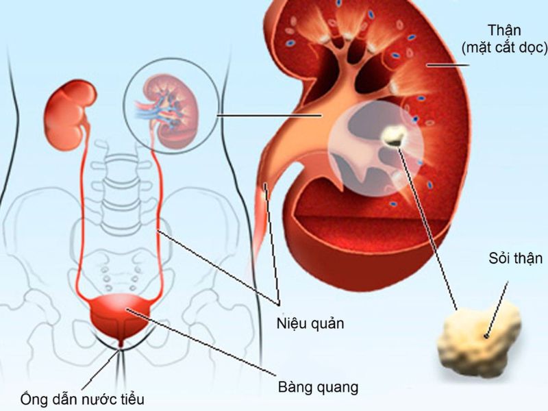 Đau bụng giữa là gì? Nguyên nhân và các biện pháp hỗ trợ hiệu quả Sỏi thận có thể gây đau vùng bụng bên trái, bên phải hoặc cả hai