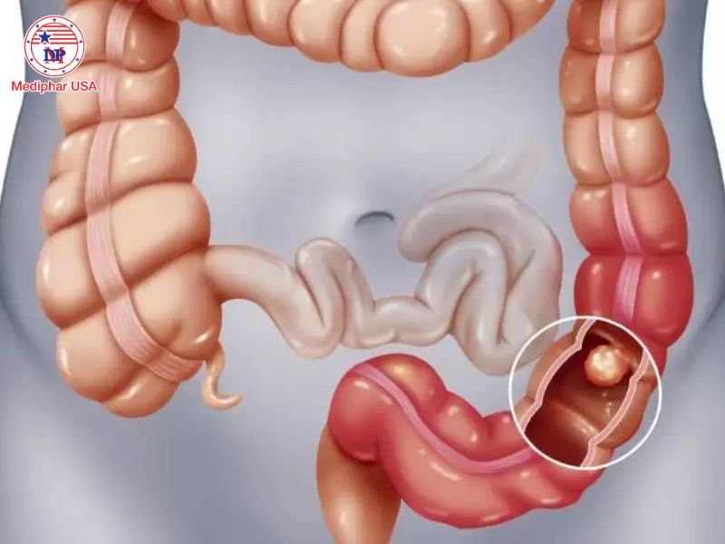 Đau bụng quanh rốn: Nguyên nhân, chẩn đoán và hướng xử trí đau bụng quanh rốn