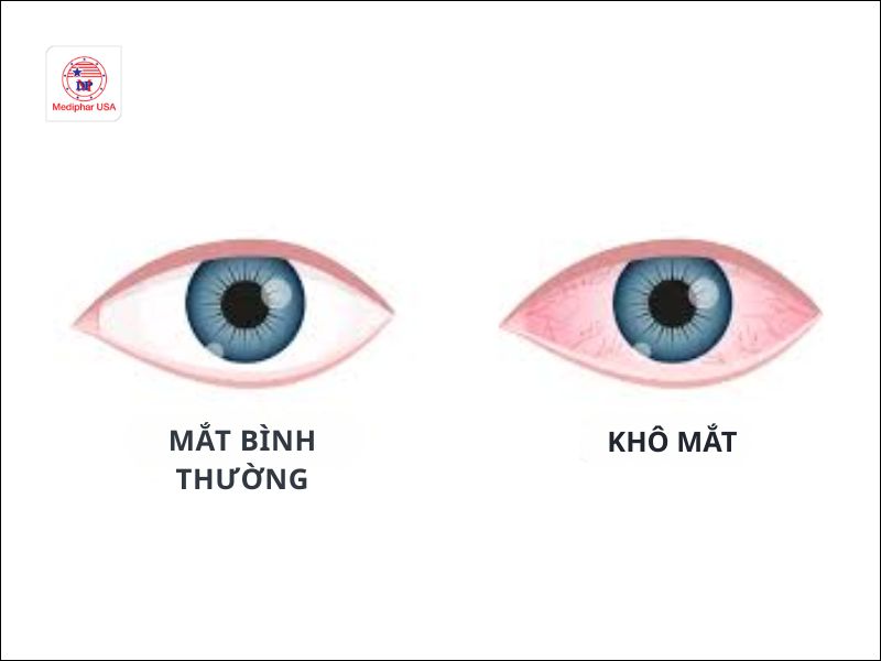 Mắt bị cộm nhưng không có bụi: Nguyên nhân & Cách xử lý an toàn Khô mắt xảy ra khi mắt không sản xuất đủ nước mắt hoặc nước mắt bay hơi quá nhanh