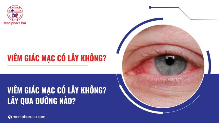 Viêm giác mạc có lây không