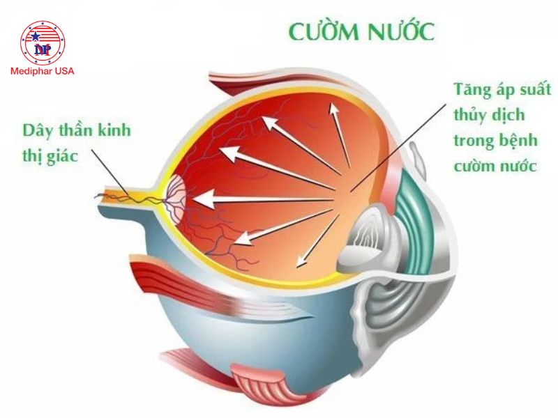 Cườm mắt là gì? Những dấu hiệu âm thầm cảnh báo không nên bỏ qua Cườm nước gây tổn thương dây thần kinh thị giác