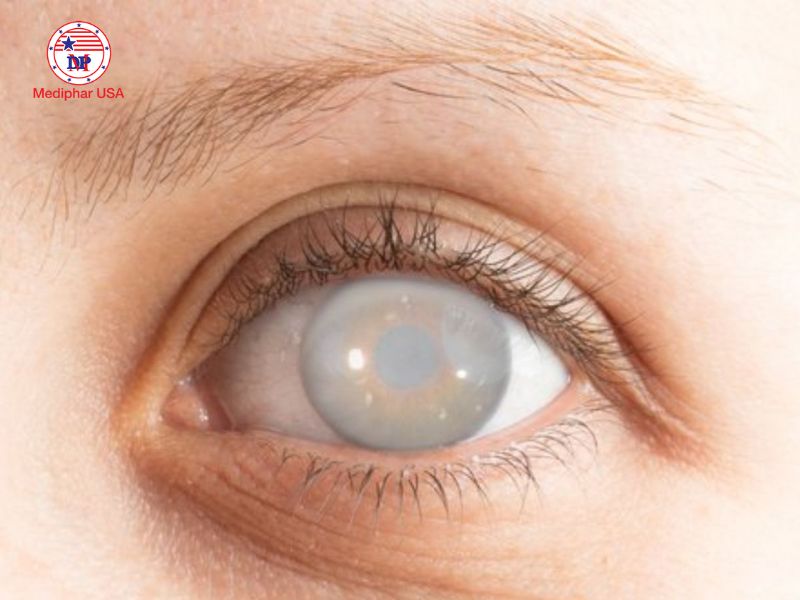 Cườm mắt là gì? Những dấu hiệu âm thầm cảnh báo không nên bỏ qua Cườm mắt dẫn đến nhiều biến chứng nếu không điều trị kịp thời