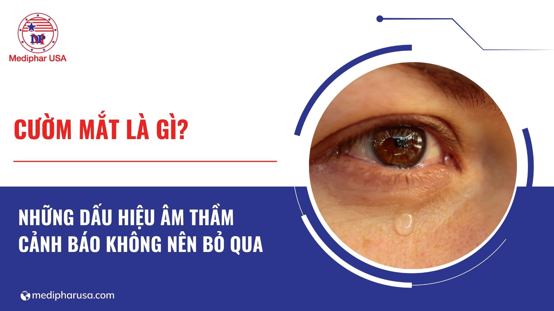 Cườm mắt là gì? Những dấu hiệu âm thầm cảnh báo không nên bỏ qua