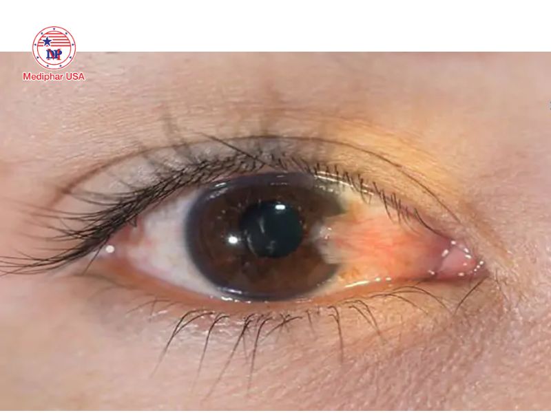 Giác mạc: Cấu trúc, chức năng và các bệnh lý thường gặp Hình ảnh bệnh nhân bị mộng thịt giác mạc