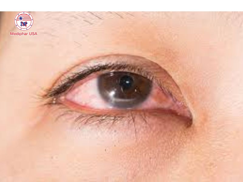 Giác mạc: Cấu trúc, chức năng và các bệnh lý thường gặp Xước giác mạc là một bệnh lý phổ biến ở mắt
